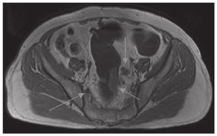 T1 weighted image without fat suppression showed tumour invasion of the surrounding fat tissue and two lymph nodes showed the same signal intensity at the left and right side of the intestinal walls