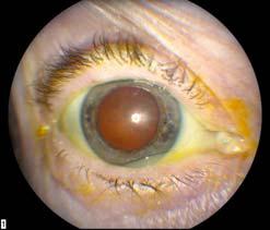 Types of Cataracts: Cortical Types of Cataracts: Posterior Subcapsular Cataract Surgery When do I need surgery?