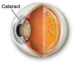 Cataract A cataract is a clouding of the lens in your eye. It affects your vision. Cataracts are very common in older people.