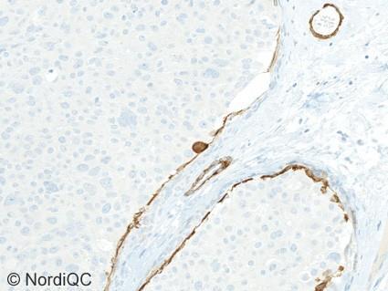 Only a weak and patchy staining reaction is seen in the myoepithelial cells lining the breast glands. Fig.