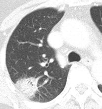 zone. (b) Axial CT thorax confirms the presence of infective consolidation in