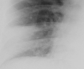 Fig 3a b c Fig 3 A 58 year old male with h/o breathlessness.