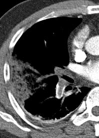 in right lower lobe supplied by thrombosed pulmonary artery