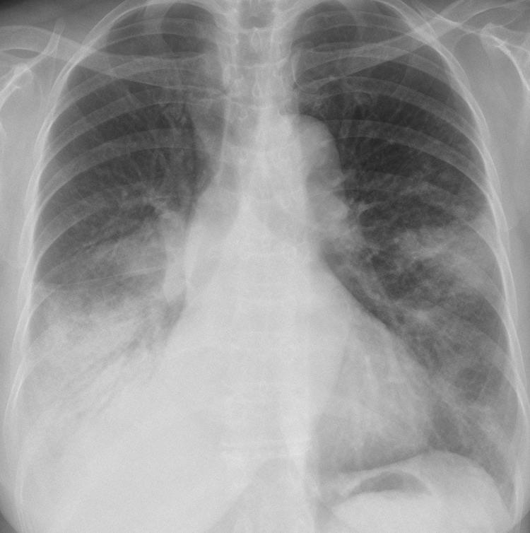 Multiple air space opacification Fig 5 A 59 year-old woman with h/o fever and cough.