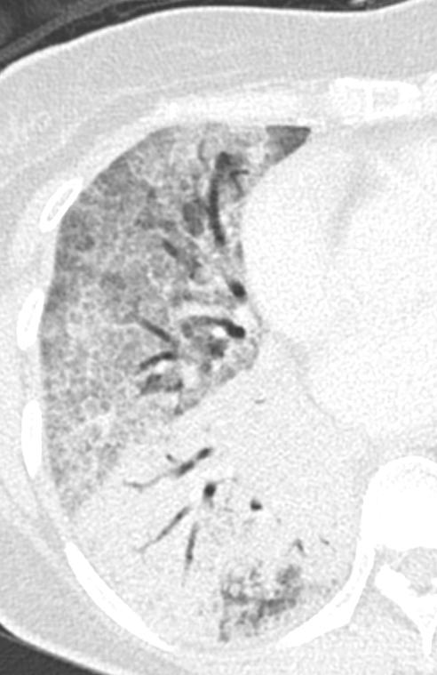 (b) CT thorax confirms the presence of extensive areas of parenchymal consolidation with air Fig 5a Air bronchogram b bronchogram and
