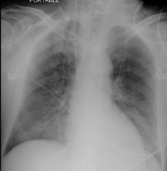 thickening, cardiomegaly and prominent pulmonary artery in keeping with cardiogenic