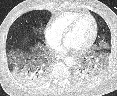 Fig 7a Chest radiograph in critically ill patient shows diffuse airspace opacities in