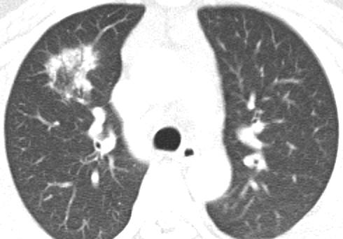 opacity in the lung periphery (arrows).