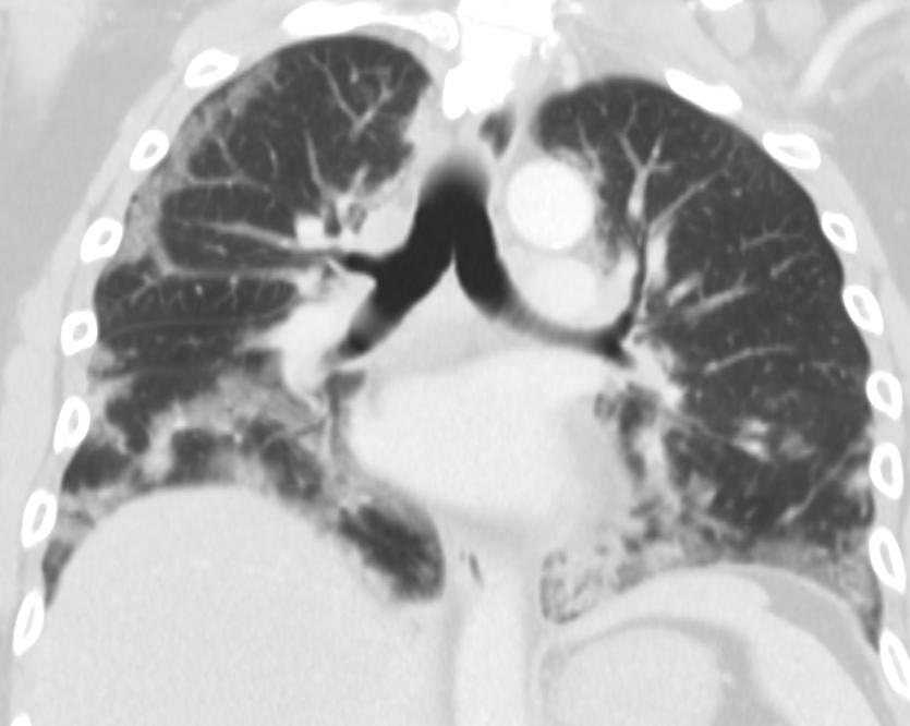 (a) Chest radiograph shows patchy areas of airspace