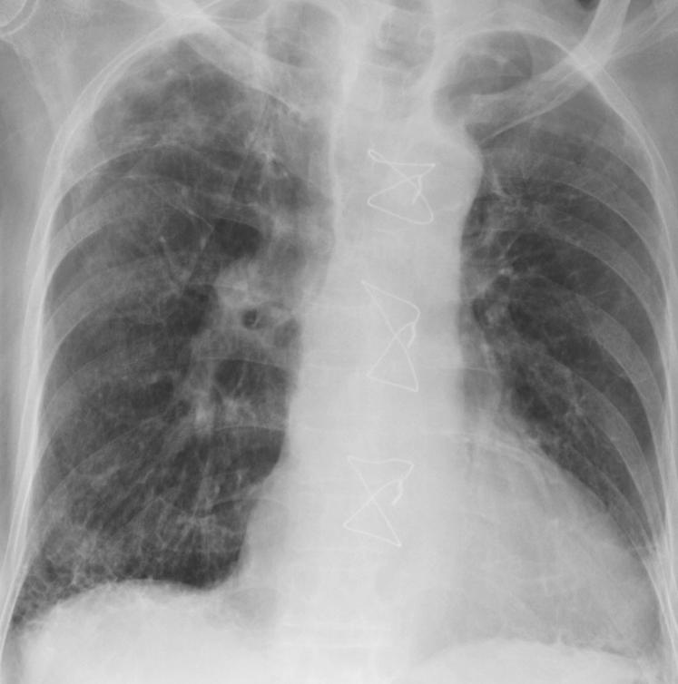 (1a) Chest radiograph shows reticular markings in bilateral lower