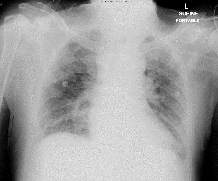 Fig 17a b Fig 17 A year old patient with breathlessness and h/o