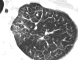 (a) Chest radiograph shows reticulonodular opacities in both lungs.