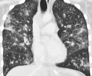 interstitial thickening in both lungs in keeping with lymphangitis