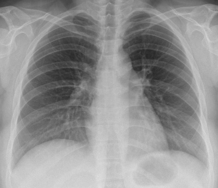 Tool 4: Other Radiographic tools for ILD Thoracic and extra thoracic associations with ILD Example : Mediastinal adenopathy = Sarcoidosis, TB.