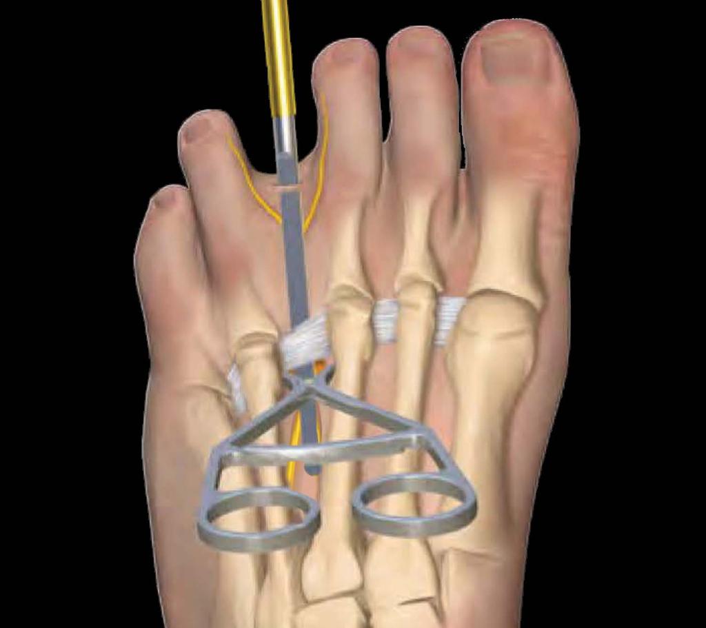 spreader between the metatarsal shafts. Make the transverse webspace incision, measuring up to a centimeter.