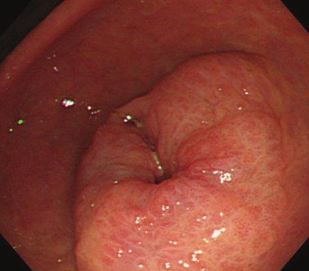 2 Case Reports in Surgery Figure 1: Upper gastrointestinal endoscopy revealed a circumferential tumor located at the antrum of the stomach.