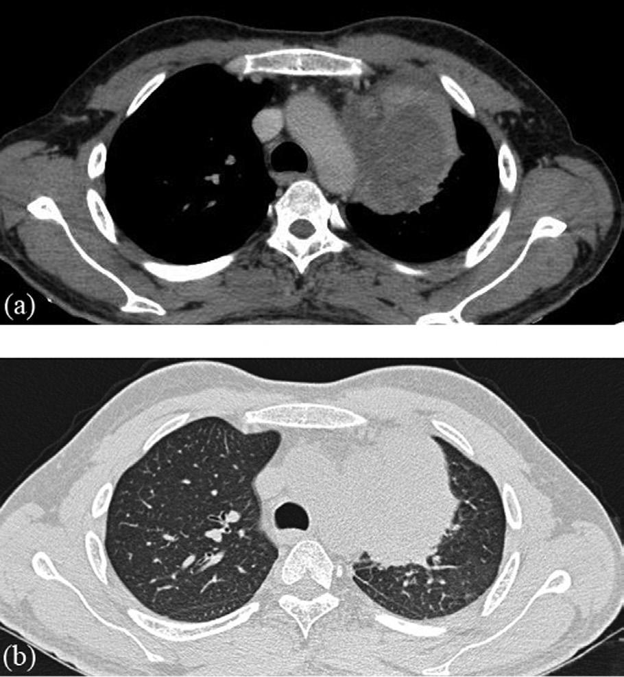 Case Report A diagnostic dilemma a lung mass, for which he was referred. On examination, the patient was thin and febrile (38.5 C) with a heart rate of 94 beats/minute.