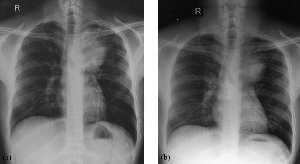 Moreover, the patient was not on corticosteroids or on any other immunosuppressive drugs. This was an extremely rare presentation of pulmonary cryptococcosis.