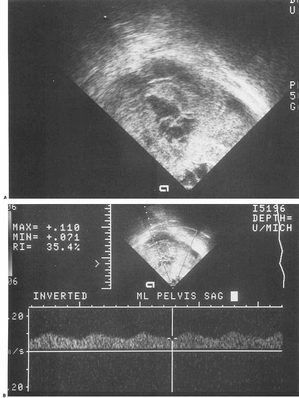 CASE REPORT: NEWMAN AND ADLER FIGURE 1. (A) Sagittal, midline pelvic sonogram with endovaginal probe. Complex mass is evident with no visible uterine contours.