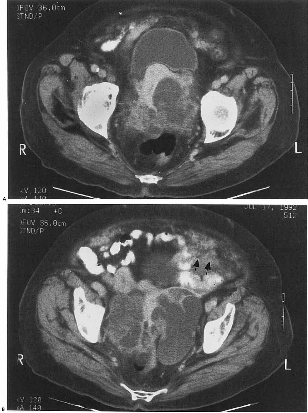 METASTATIC COLONIC ADENOCARCINOMA FIGURE 2. (A) Pelvic CT scan at level just below bladder dome revealing the inferior aspect of the mass deforming the uterus.