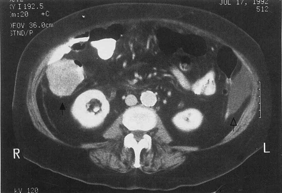 CASE REPORT: NEWMAN AND ADLER FIGURE 3. Abdominal CT scan at level of kidneys revealing a large cecal mass (arrow).