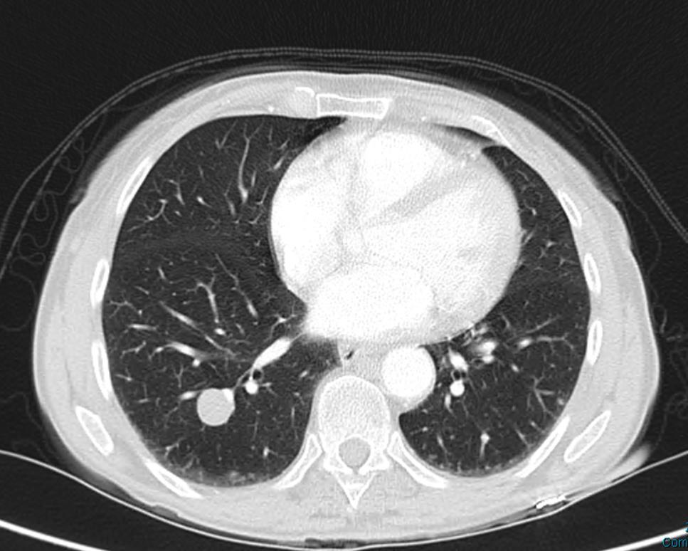 only Partial shrinkage of lung secondary tumours Patient remains well and