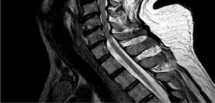 Surgical Treatment of Cervical Compressive Myelopathy (CONFIRMED)