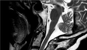 flavum and changes in PLL. Figure 4 Dynamic MRI Cspine of case 1.