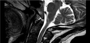 MRI showed myelomalacia at C3-4 level.