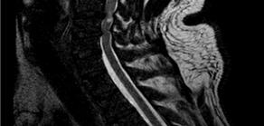 changes in PLL. Figure 6. Dynamic Cervical MRI of case 3.