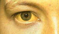 Jaundice is caused by a buildup of a product of red blood cell breakdown in the