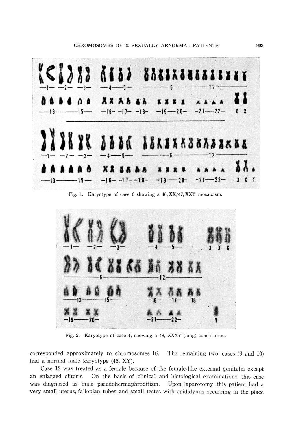 CHROMOSOMES OF 20 SEXUALLY ABNORMAL PATIENTS 293 Fig. 1. Karyotype of case 6 showing a 46, XX/47, XXY mosaiclsm. Fig. 2. Karyotype of case 4, showing a 48, XXXY (long) constitution.