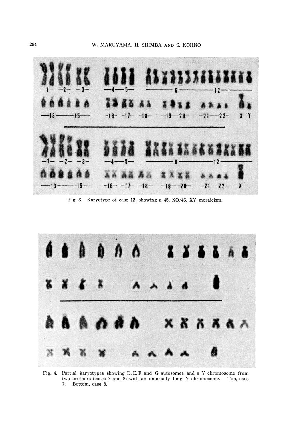 294 W. MARUYAMA, H. SHIMBA AND S. KOHNO Fig. 3. Karyotype of case 12, showing a 45