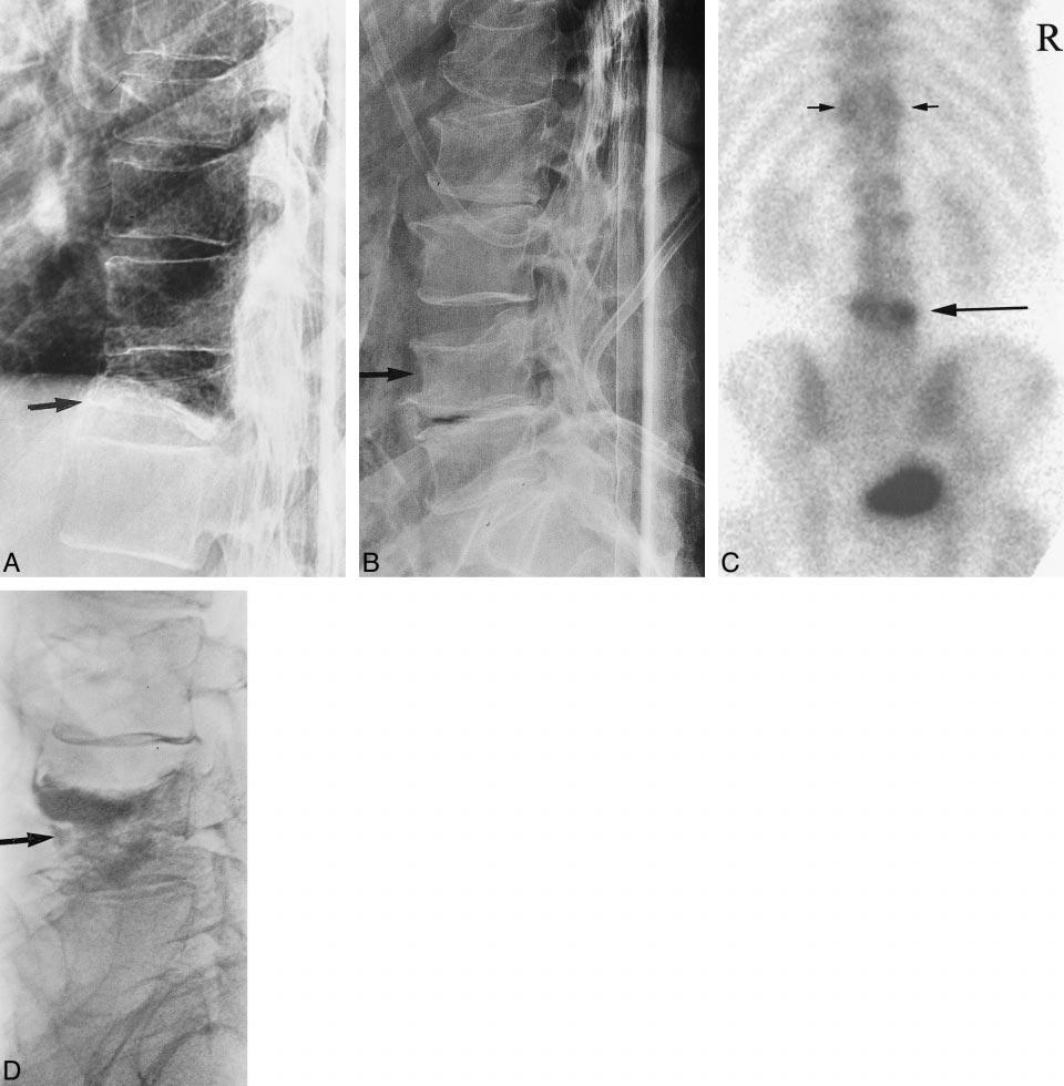 AJNR: 21, November/December 2000 OSTEOPOROTIC VERTEBRAL FRACTURES 1809 FIG 1. Images from the case of a 79-year-old man who presented with a history of back pain of several months duration.
