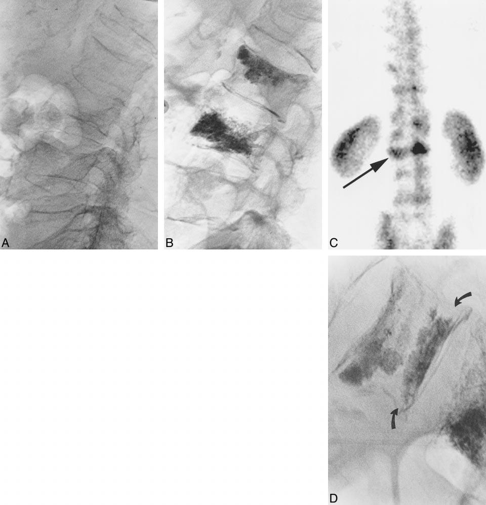 1810 MAYNARD AJNR: 21, November/December 2000 FIG 2. Images from the case of a 77-year-old man who presented with back pain of 3 months duration.