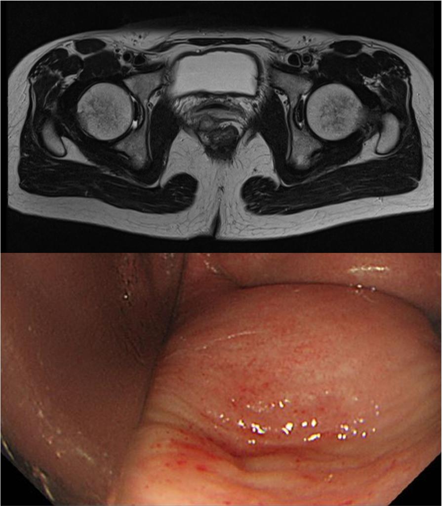In December 2013, 9 months after ISR, she presented with anal pain and purulent perineal discharge.