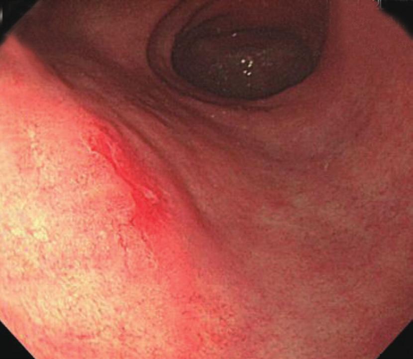 Delayed Perforation Occurring after ESD Case 1 An 86-year-old man was referred