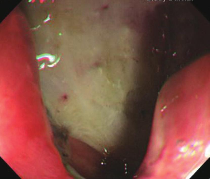 A tumor was located on the anterior wall of the antrum.