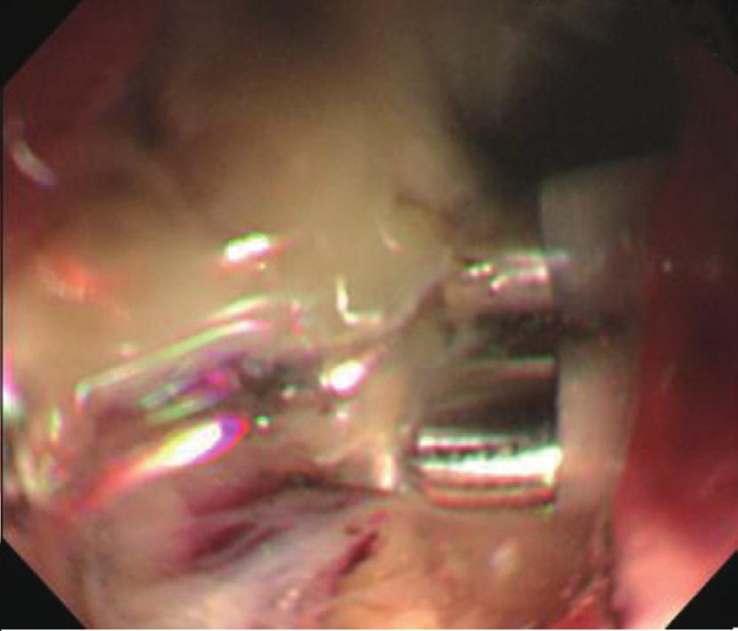 2 cm-sized type IIc early gastric cancer lesion on the anterior wall of the