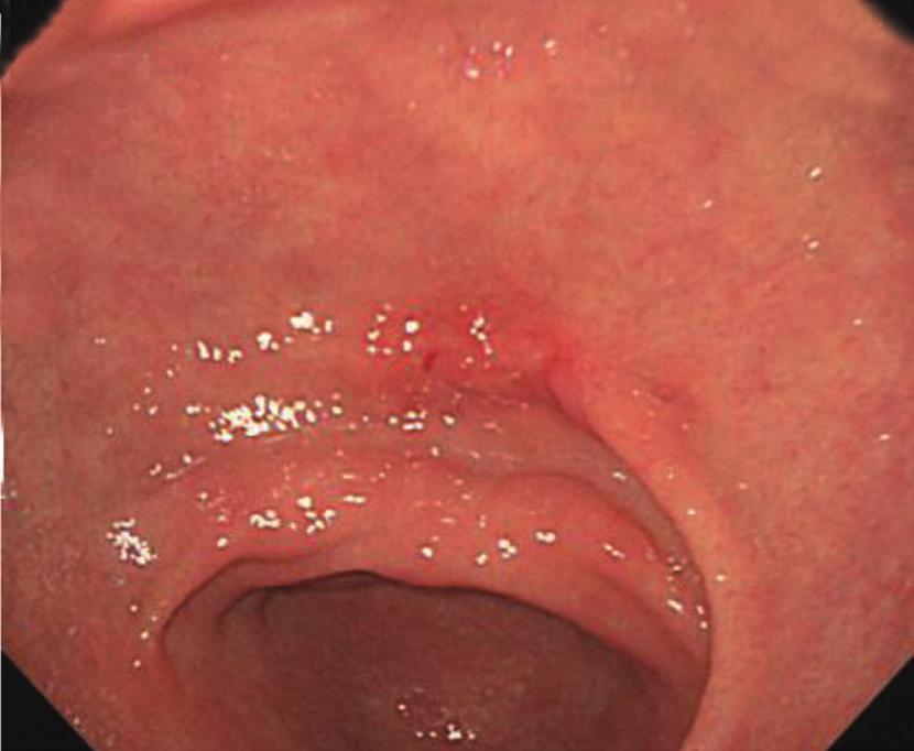 A 3 cm-sized laceration is found at the previous endoscopic submucosal dissection site, and primary open repair is performed. performed immediately after ESD (Fig. 2A).