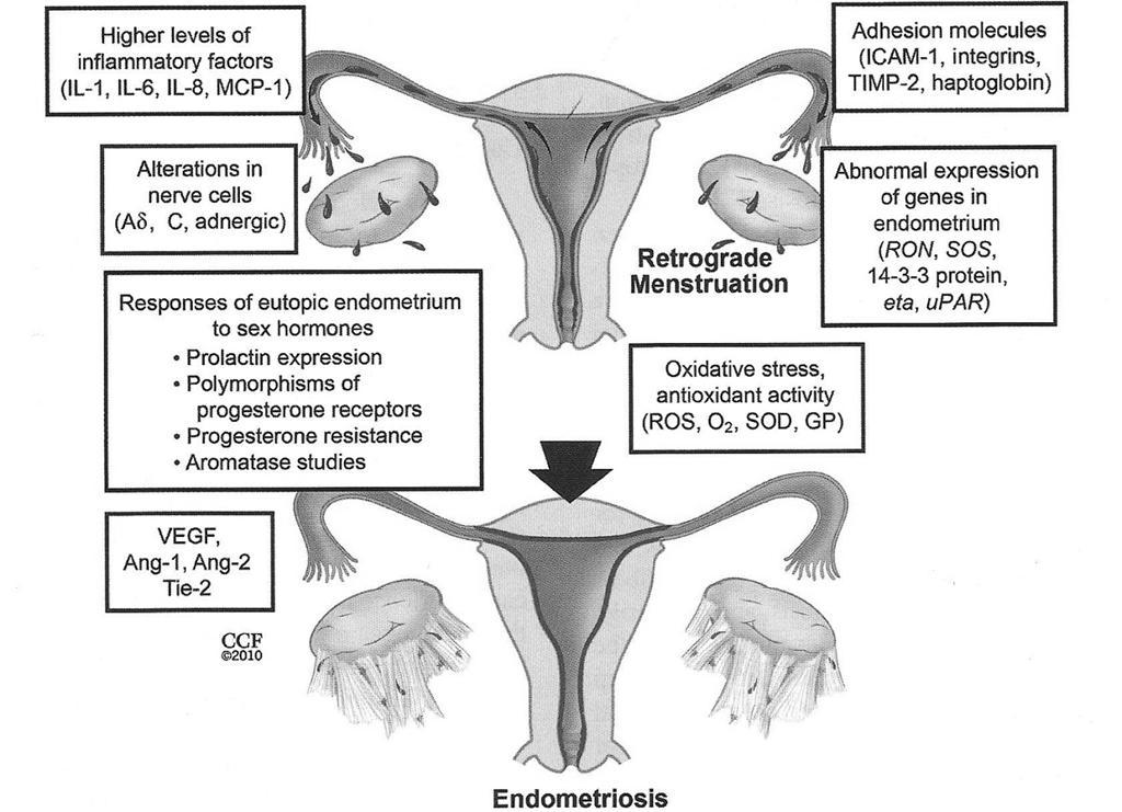 ENDOMETRIOSIS Most authorities believe endometriosis results from retrograde menstruation and subsequent implantation of endometrial glands and stroma outside of the uterus.