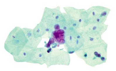 Technology Principles CellDetect histochemical stain has been demonstrated to differentiate between normal and neoplastic cells by color alongside morphological features