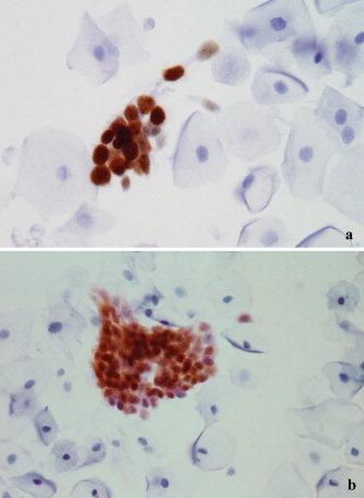 38 Immunocytochemistry Cervix Liquid-based cytology HSIL MIB1 p16 INK4a Sahebali et al Immunocytochemistry in liquid based