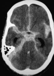 5 Table 4: showing CT findings in cranio-cerebral trauma. CT findings Number of Percentage patients (%) Cerebral contusions 233 58.