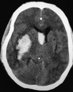 Figure 3: Axial CT image showing cortical contusion with surrounding edema in the left temporal lobe and pneumocephalus.