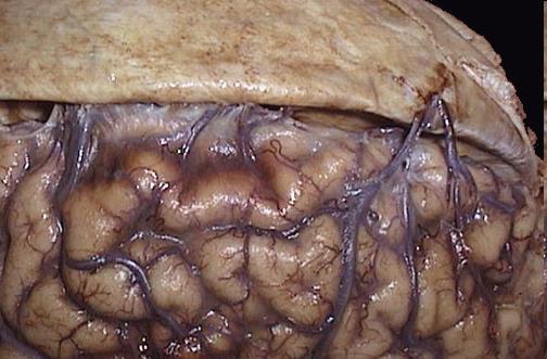 The dura has been reflected above to reveal the bridging veins that extend across to the superior aspect of the cerebral