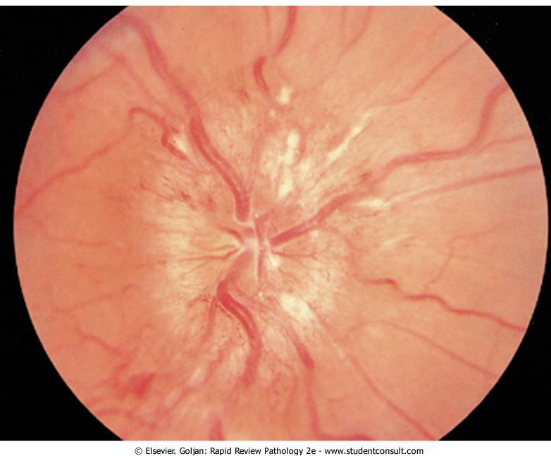 Optic disk with papilledema showing loss of