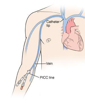 How are HML and PICC lines similar Tip placement in superior vena cava Catheter material is soft & flexible Require