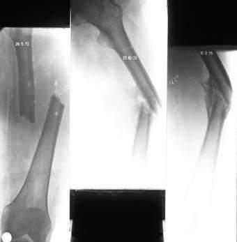 Fracture healing A broken bone heals because......it is broken! Dr.