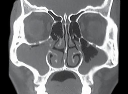 Abhishek Ramadhin Table 2: Lund-Mackay score of CT scan Paranasal sinuses Right Left Maxillary (0, 1, 2) Anterior Ethmoid (0, 1, 2) Posterior Ethmoid (0, 1, 2) Sphenoid (0, 1, 2) Frontal (0, 1, 2)